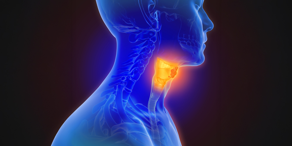 Pan-kinase inhibitor for head and neck cancer enters clinical trials